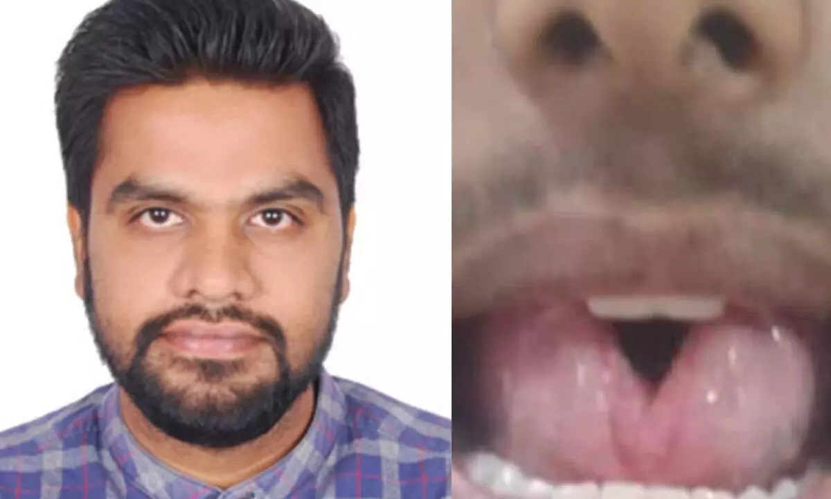 ENT surgeons restore young man's quality of life with tongue surgery