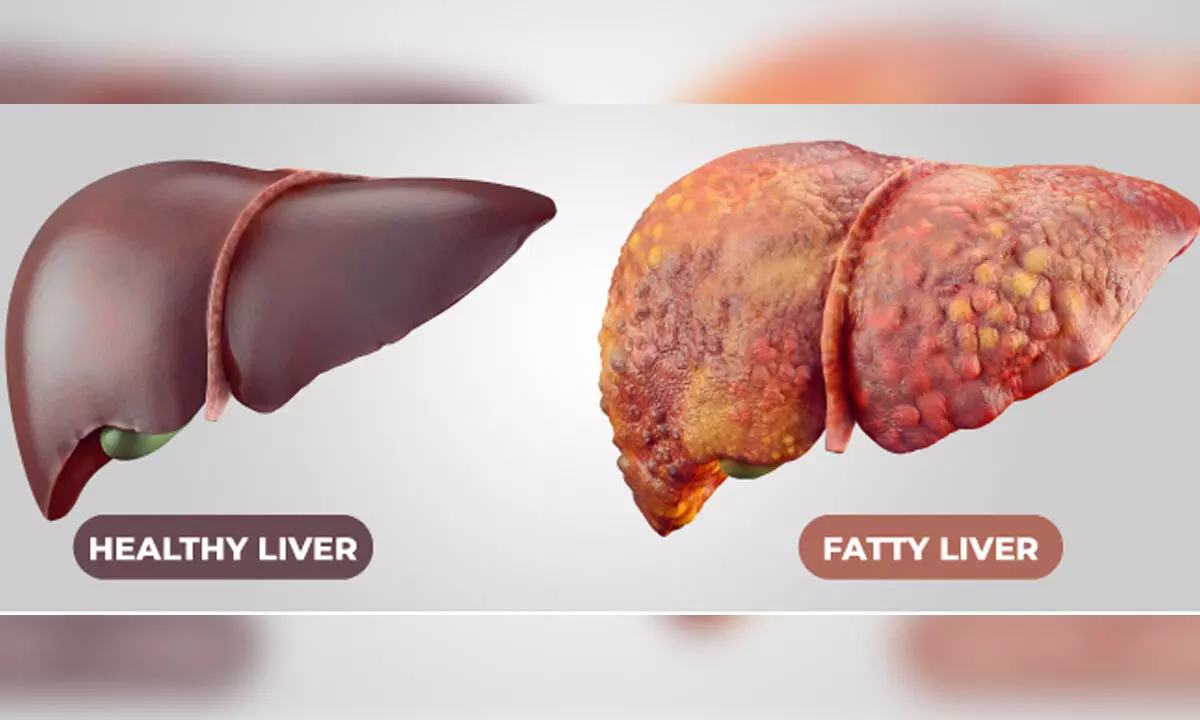 More than 80% of Indian IT employees have Fatty Liver Disease, UoH study finds